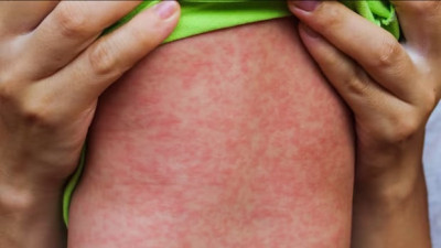 매니토바 홍역 발생률 1년 만에 최저… 전문가들 추가 확산 경고