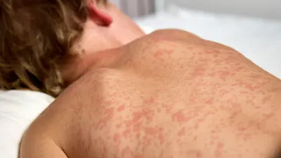 매니토바주 홍역 확산 비상… 신규 확진 25명 추가되며 전국 최대 감염지 기록