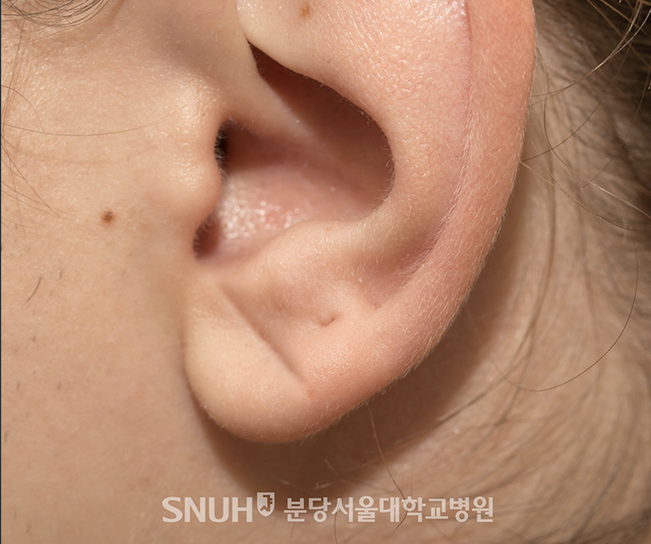 귓불에 주름 있다면?…“뇌혈관 손상 신호일 수 있어”
